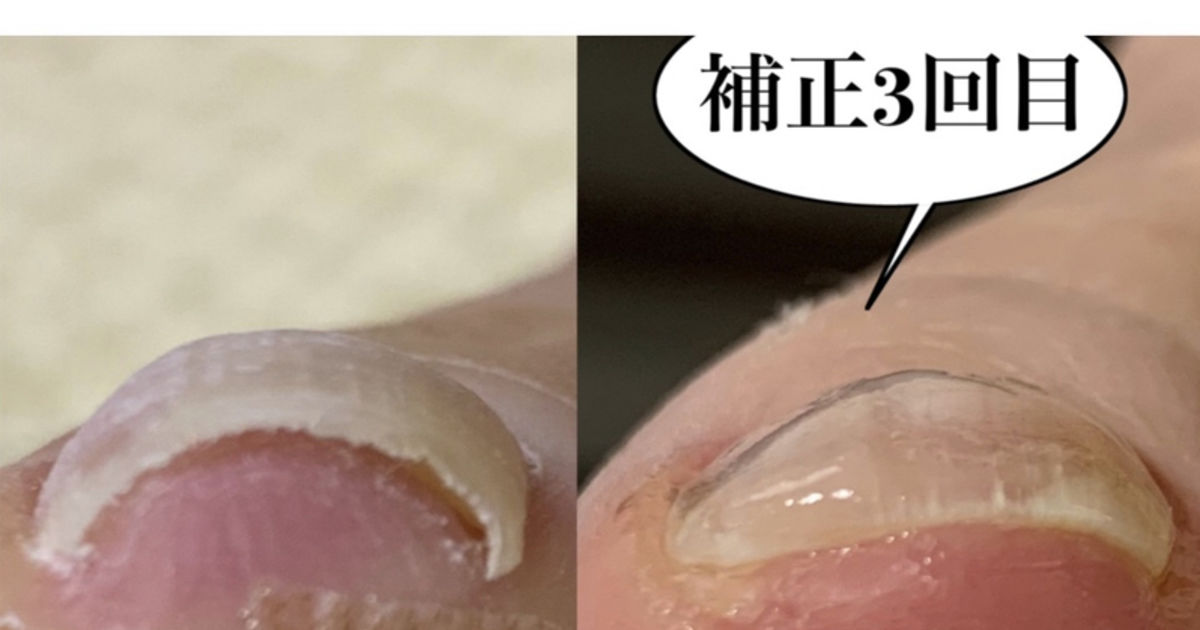 巻き爪補正 ペディグラステクノロジー